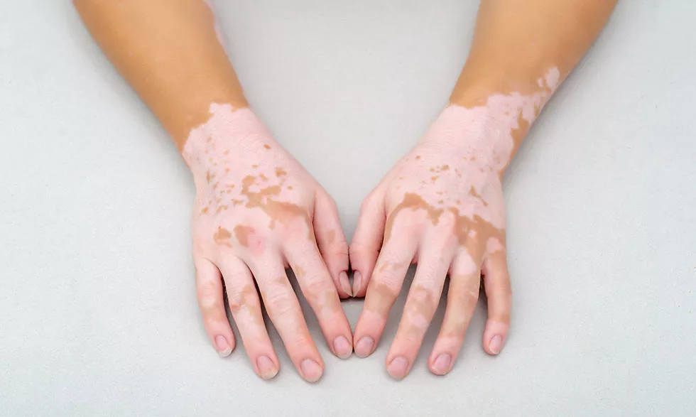 Vitiliqo Xəstəliyi Müalicəsi | Vitiliqo Nədir? | Dermatoloq Hekim